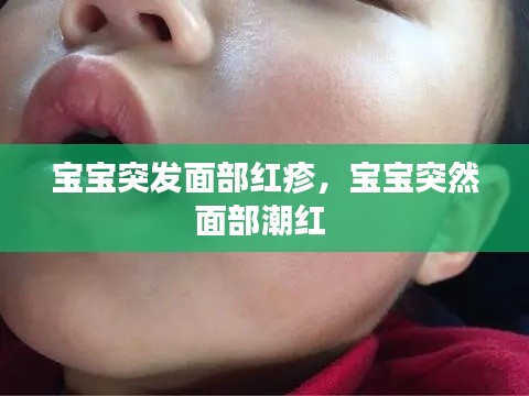 宝宝突发面部红疹,宝宝突然面部潮红